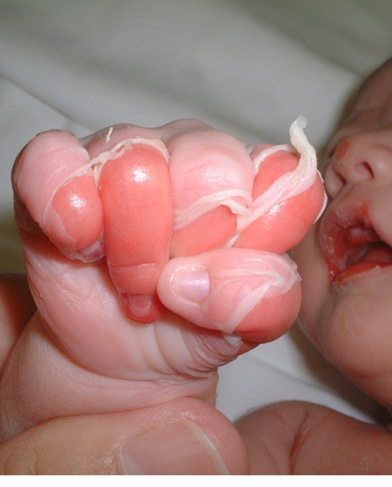 ※表皮水疱症の新生児の皮膚症状(症例写真提供/玉井克人教授)