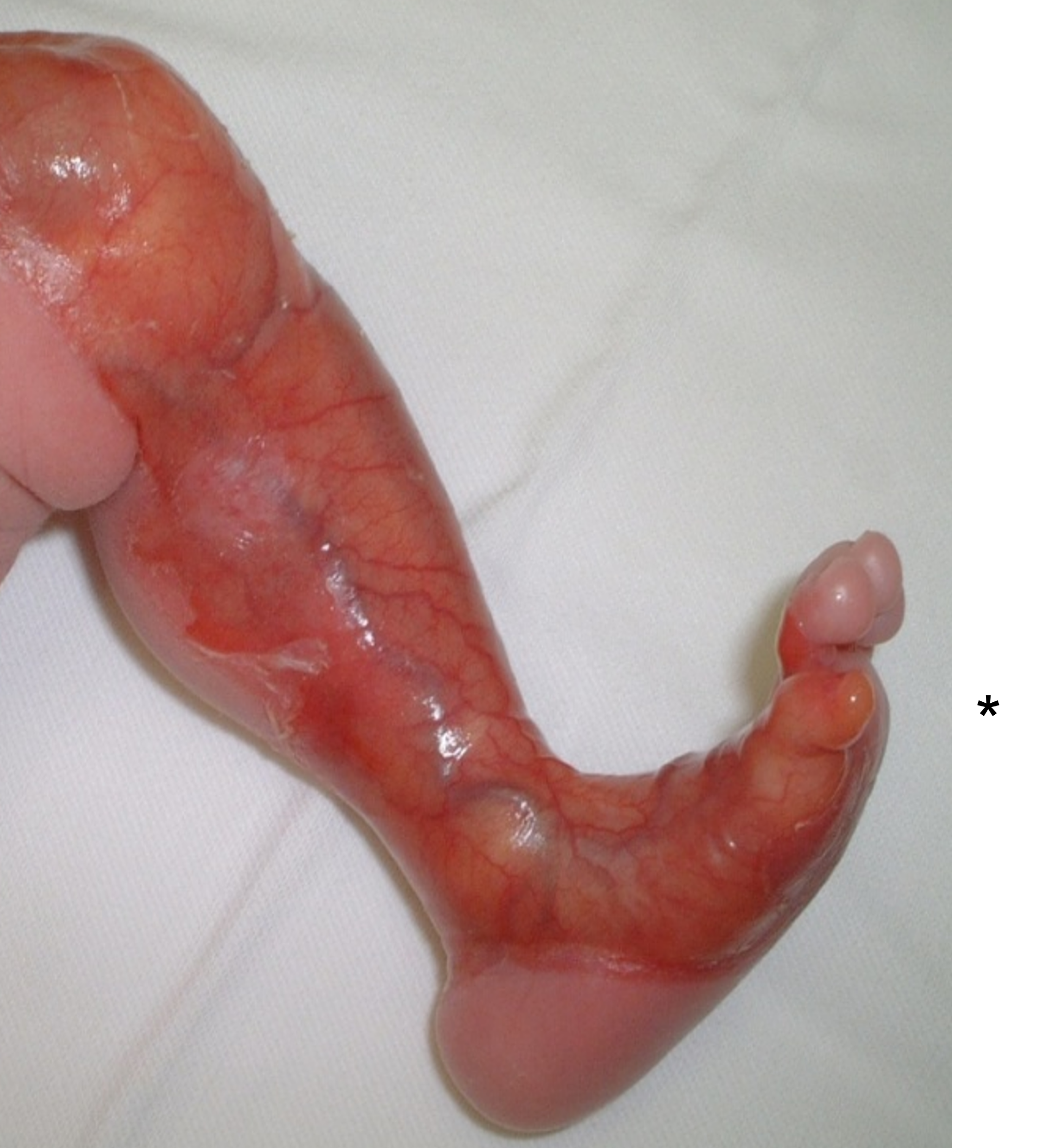※表皮水疱症の新生児の皮膚症状(症例写真提供/玉井克人教授)